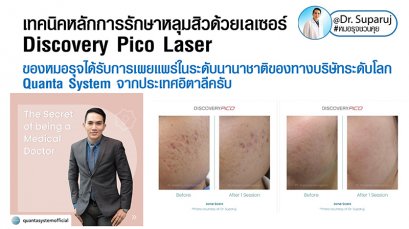 เทคนิคหลักการรักษาหลุมสิวด้วยเลเซอร์ Discovery Pico Laser ของหมอรุจได้รับการเผยแพร่ในระดับนานาชาติของทางบริษัทระดับโลก Quanta System จากประเทศอิตาลีครับ